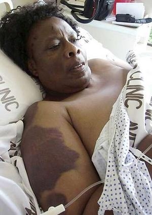 Mrs Sekai Holland in Harare hospital after the torture of March 11, 2007.